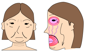 Actwell Eliminate Facial Loosening Nasolabial Folds Beauty